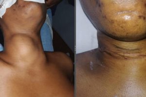 Lyn-Nach Medical Center successfully carried out first Thyroid Surgery