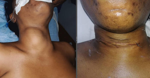 Lyn-Nach Medical Center successfully carried out first Thyroid Surgery